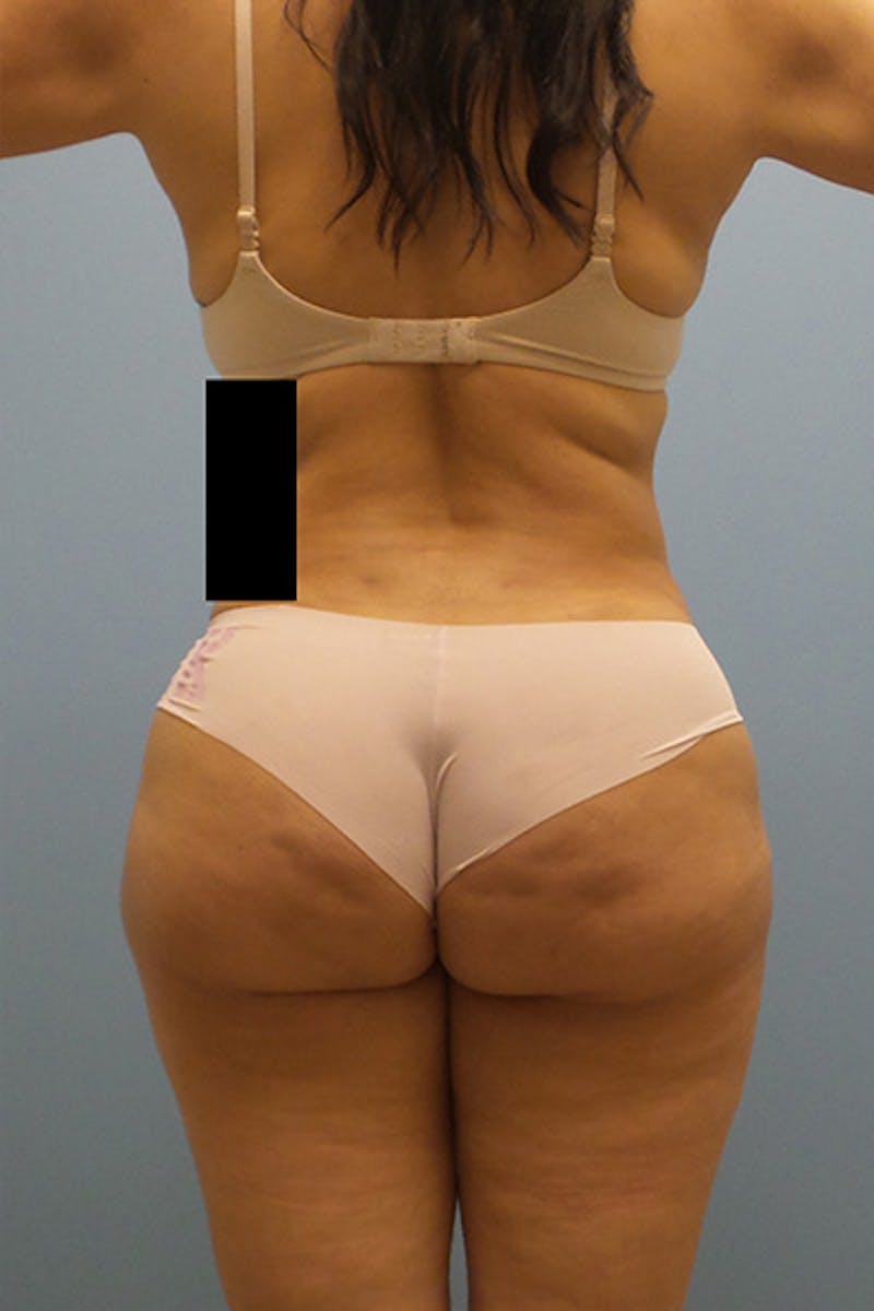 Brazilian Butt Lift Before & After Gallery - Patient 120904977 - Image 2
