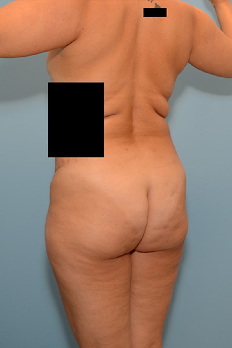 Brazilian Butt Lift Before & After Gallery - Patient 120904977 - Image 3