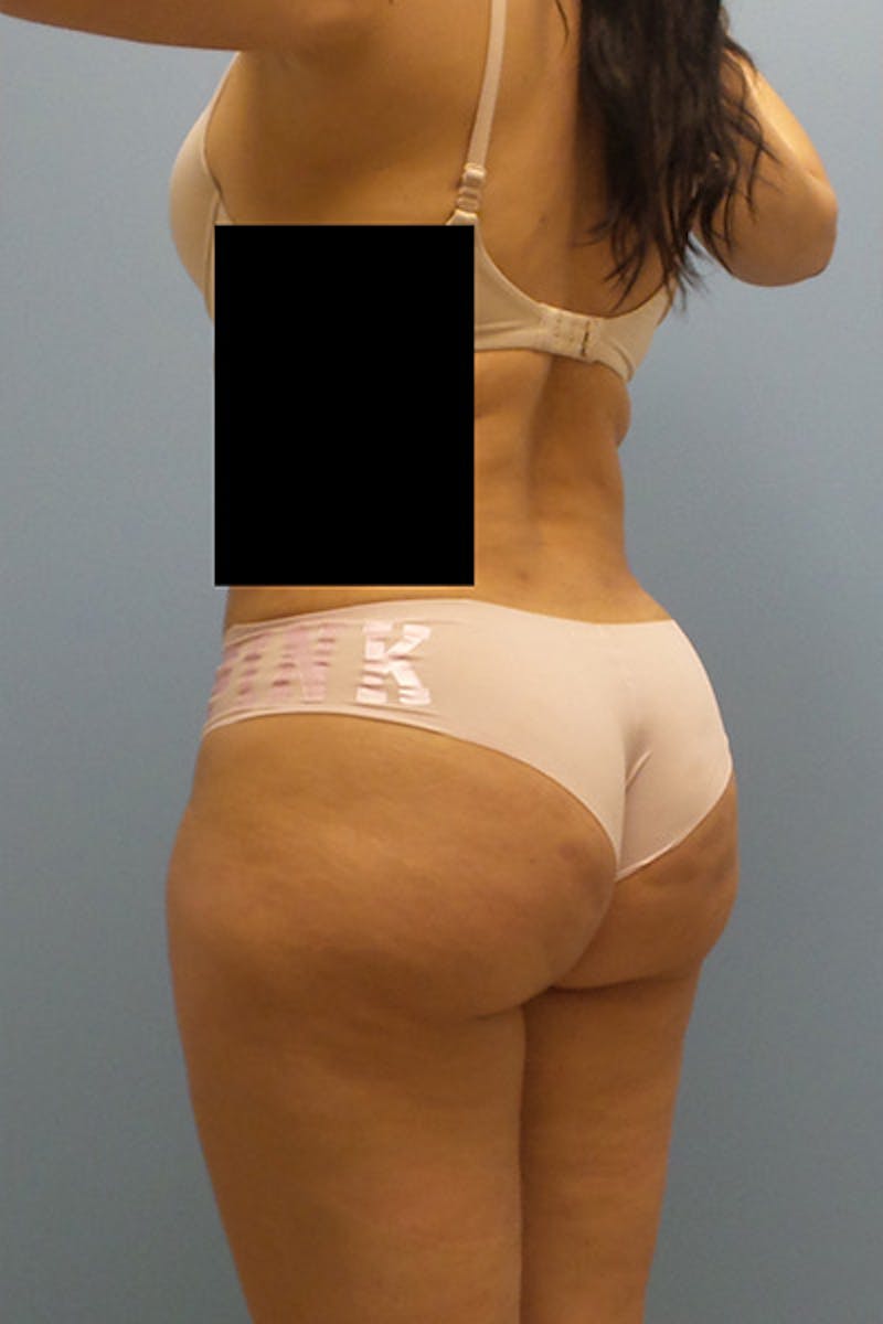 Brazilian Butt Lift Before & After Gallery - Patient 120904977 - Image 4