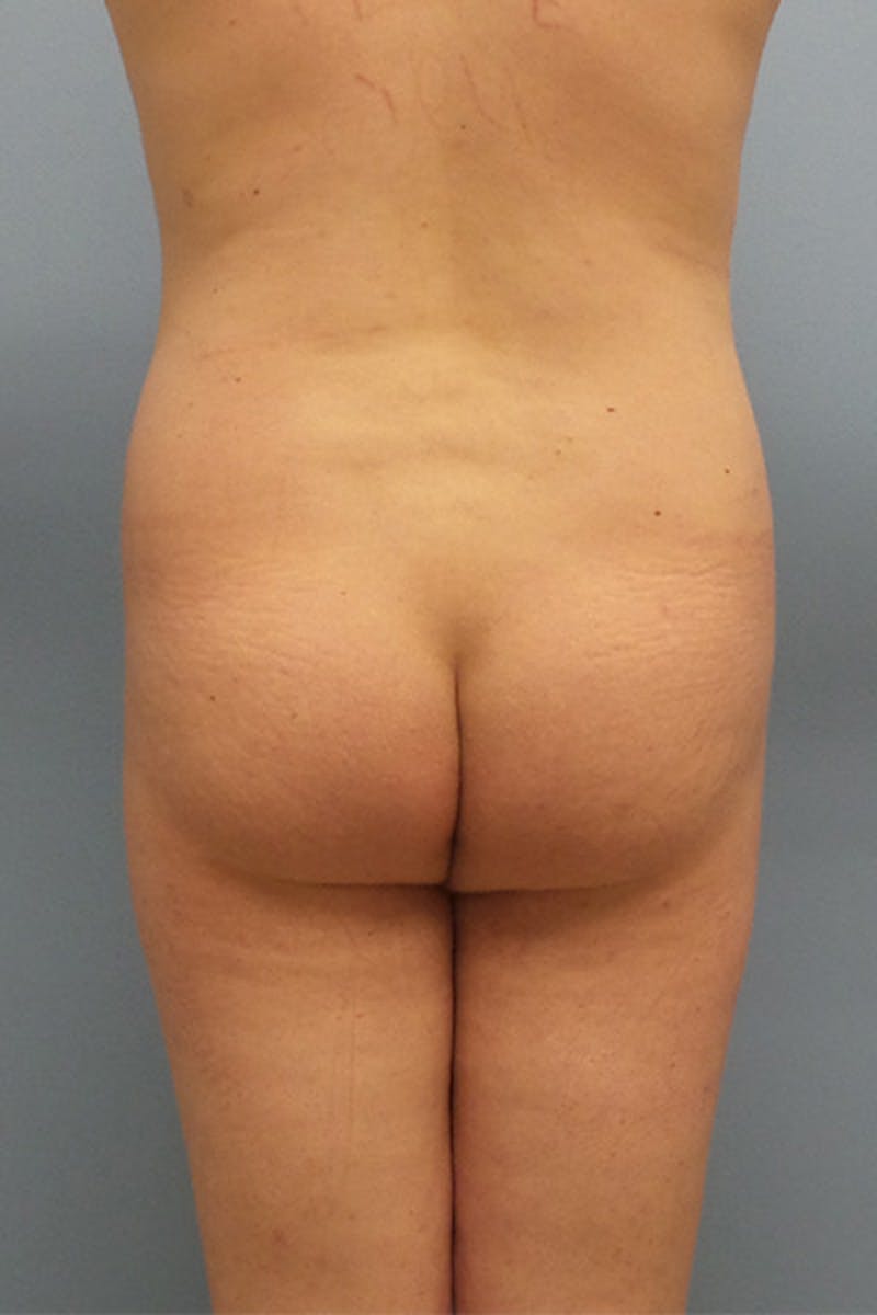 Brazilian Butt Lift Before & After Gallery - Patient 120904978 - Image 1
