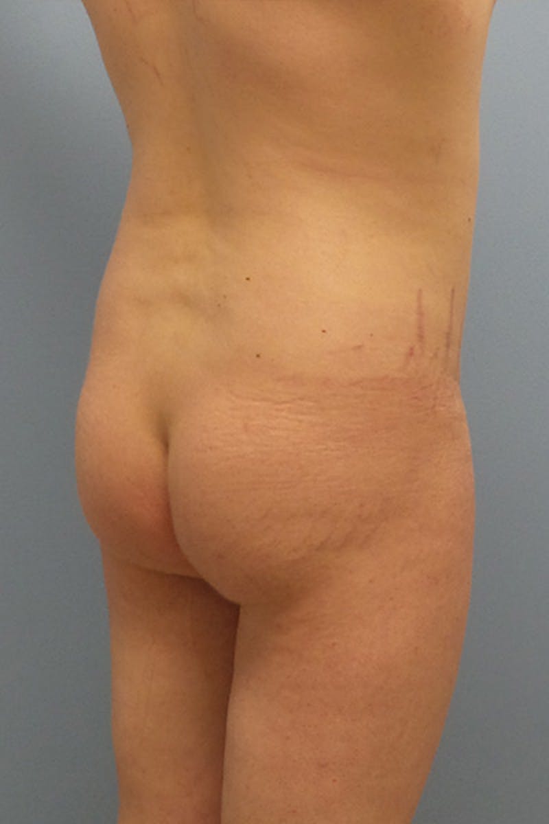 Brazilian Butt Lift Before & After Gallery - Patient 120904978 - Image 3