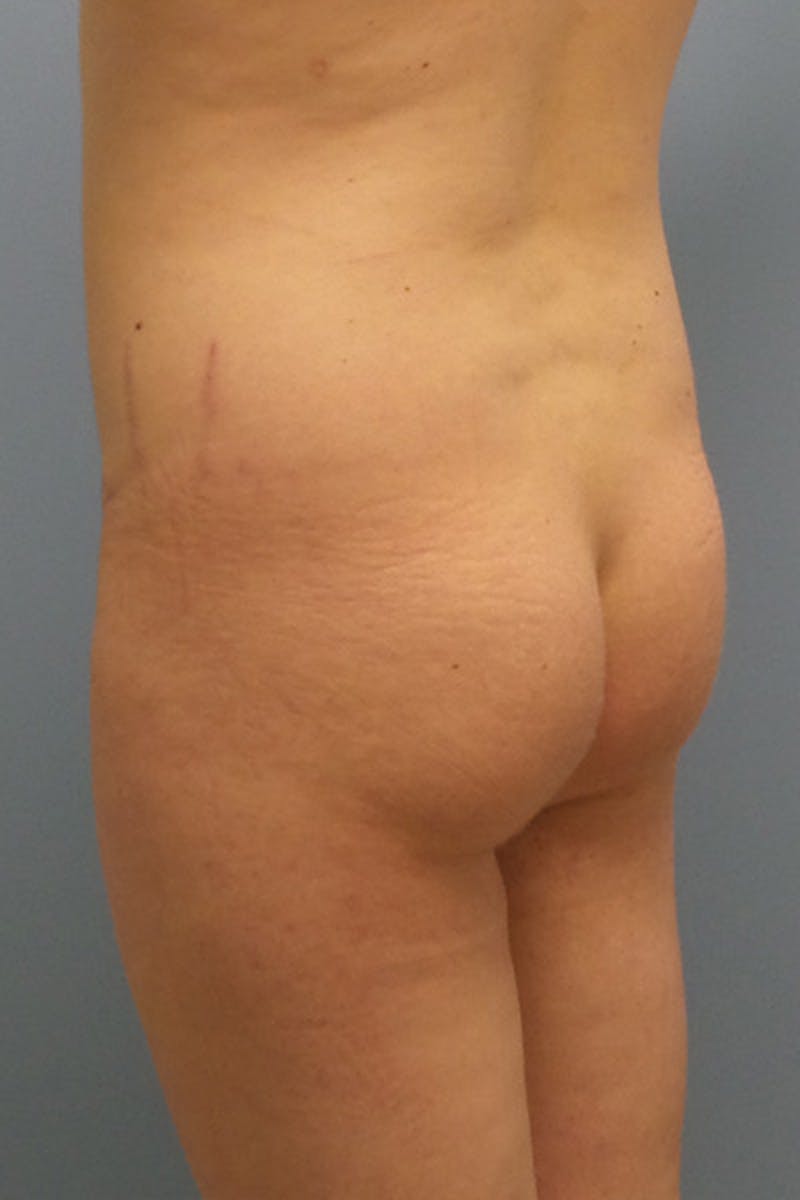 Brazilian Butt Lift Before & After Gallery - Patient 120904978 - Image 5