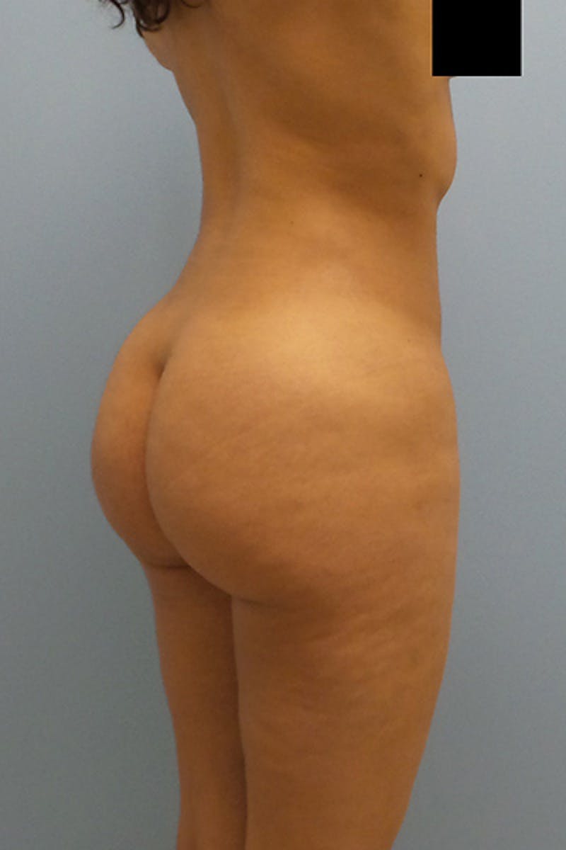 Brazilian Butt Lift Before & After Gallery - Patient 120904979 - Image 4