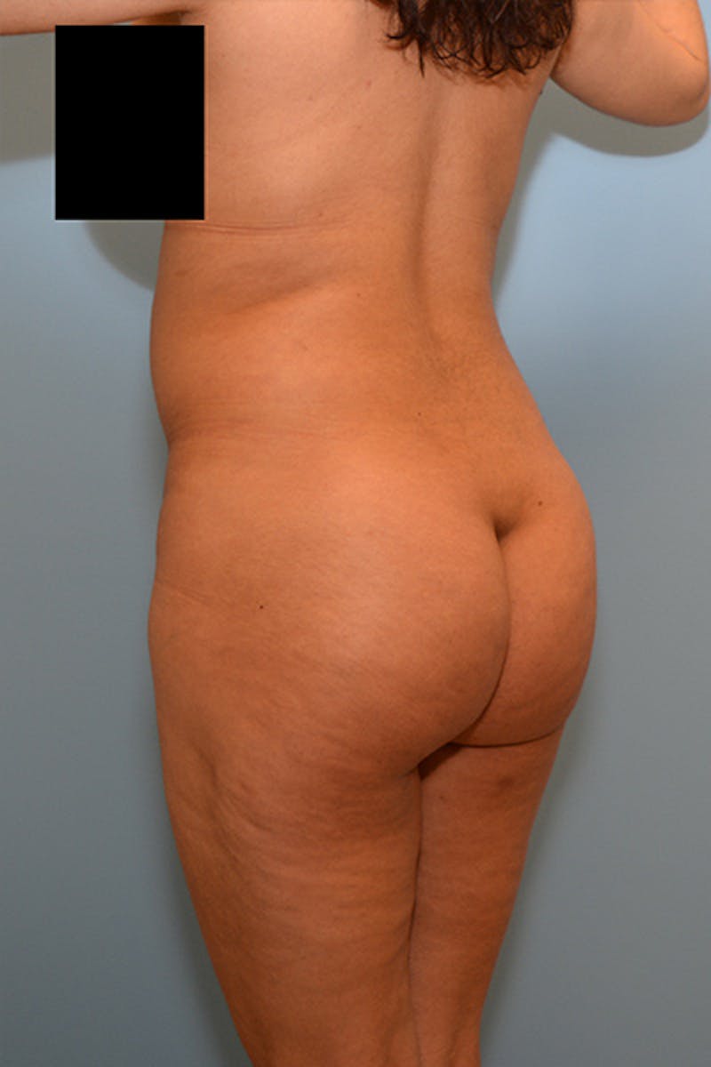 Brazilian Butt Lift Before & After Gallery - Patient 120904979 - Image 5