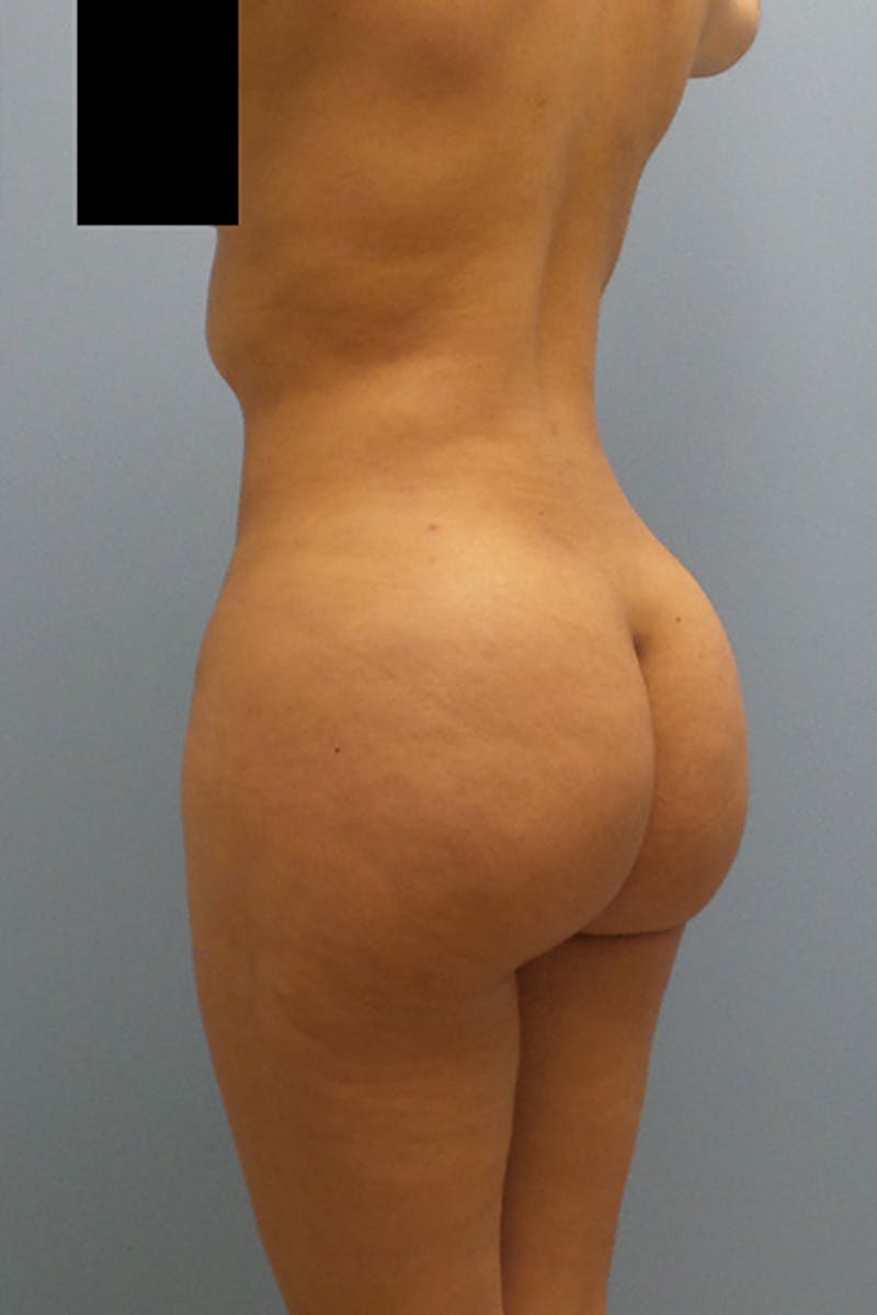 Brazilian Butt Lift Before & After Gallery - Patient 120904979 - Image 6