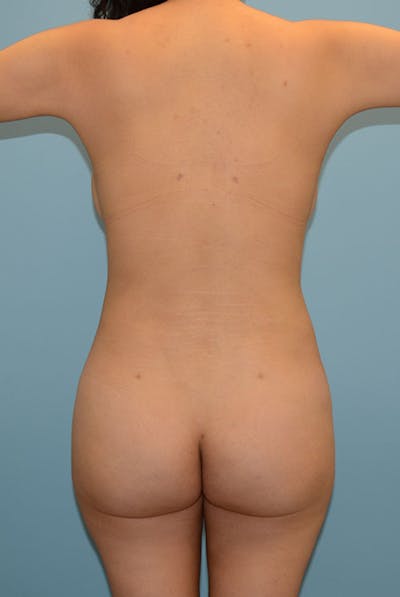Brazilian Butt Lift Before & After Gallery - Patient 120904983 - Image 2