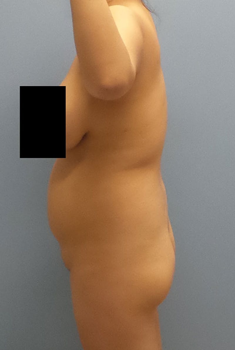 Brazilian Butt Lift Before & After Gallery - Patient 120904983 - Image 3