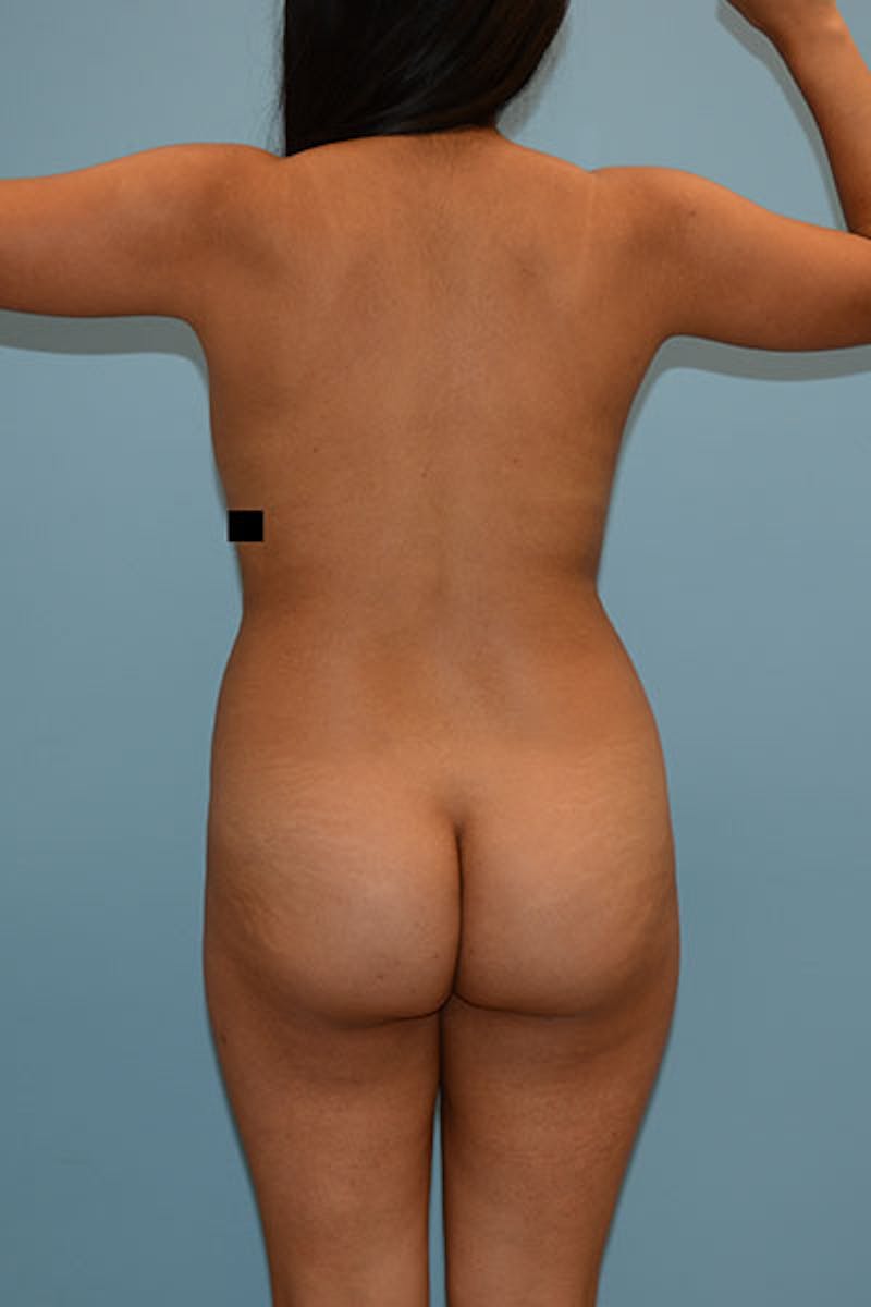 Brazilian Butt Lift Before & After Gallery - Patient 120904986 - Image 1