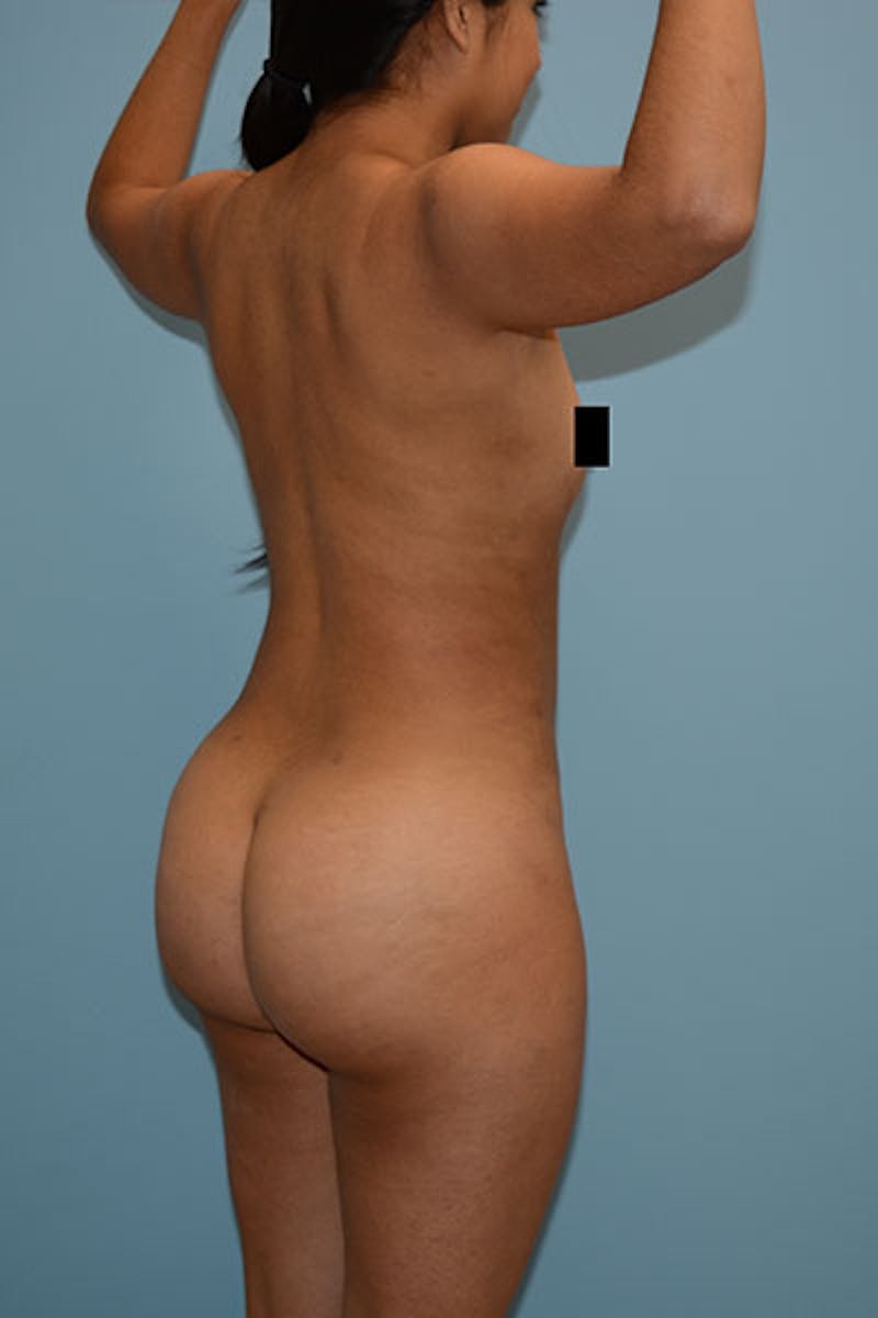 Brazilian Butt Lift Before & After Gallery - Patient 120904986 - Image 4