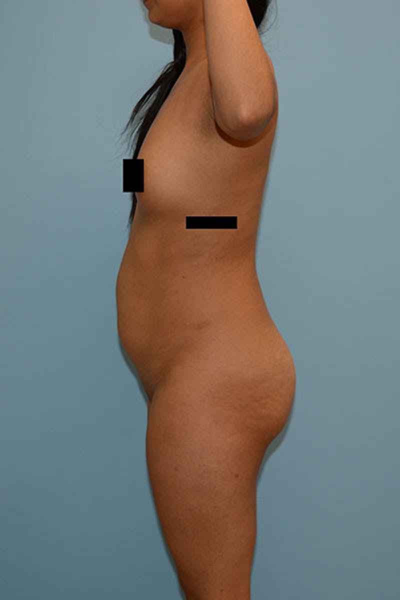 Brazilian Butt Lift Before & After Gallery - Patient 120904986 - Image 5