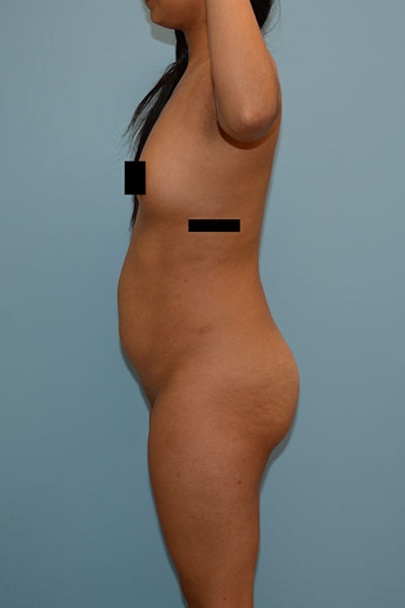 Brazilian Butt Lift Gallery - Patient 120904986 - Image 5