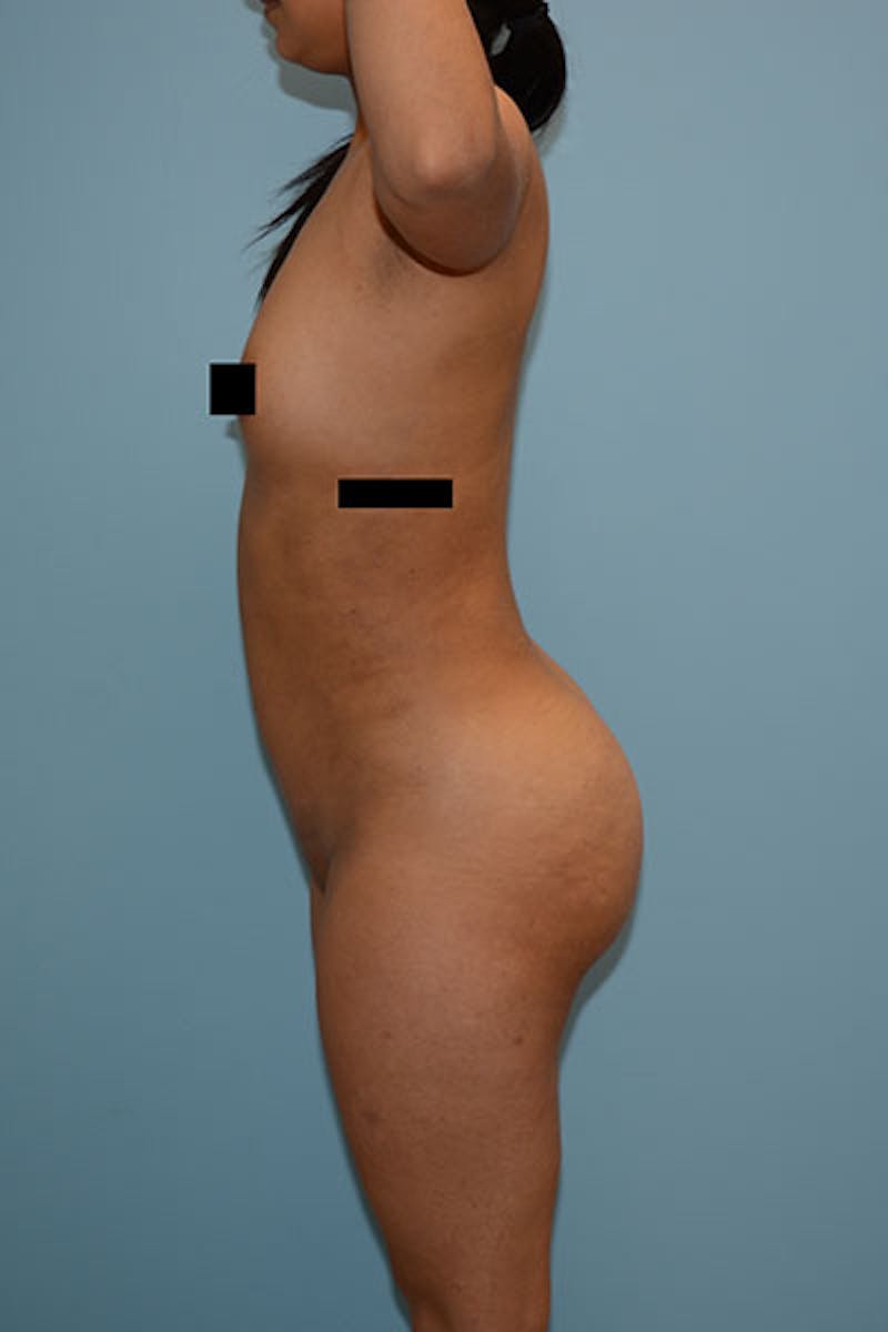 Brazilian Butt Lift Before & After Gallery - Patient 120904986 - Image 6