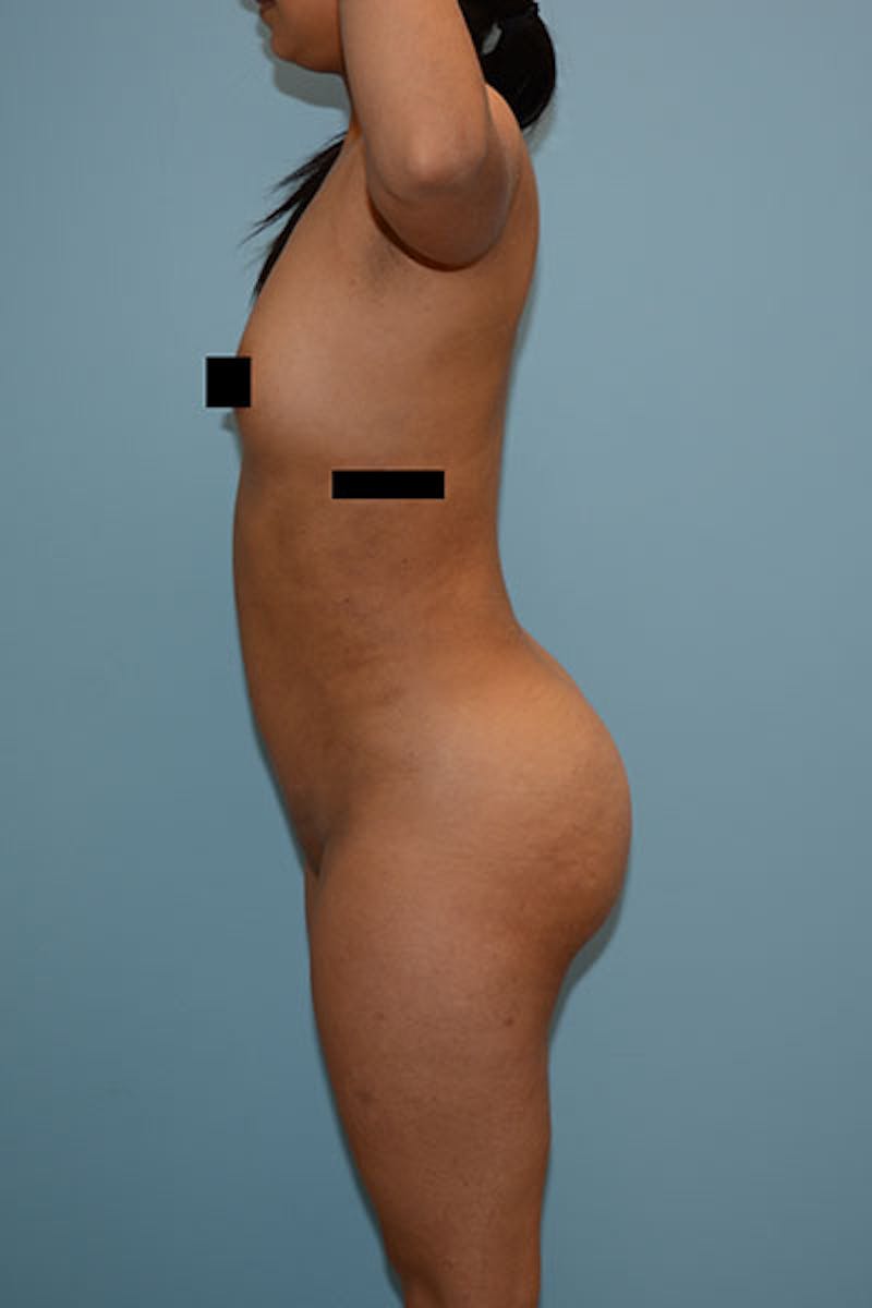 Brazilian Butt Lift Gallery - Patient 120904986 - Image 6