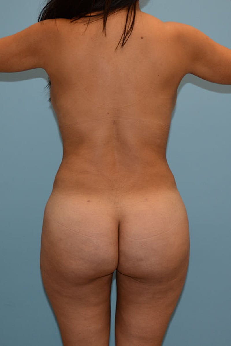 Brazilian Butt Lift Before & After Gallery - Patient 120904987 - Image 2