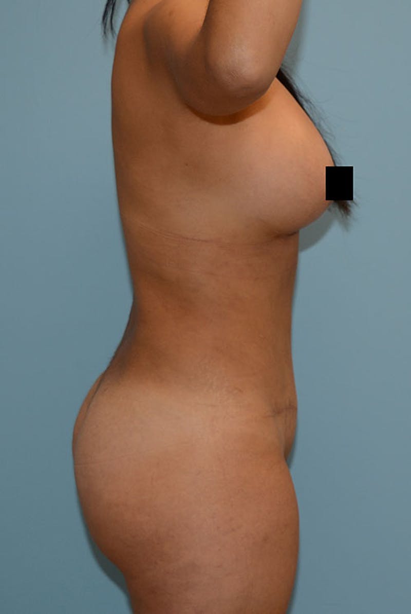 Brazilian Butt Lift Before & After Gallery - Patient 120904987 - Image 6