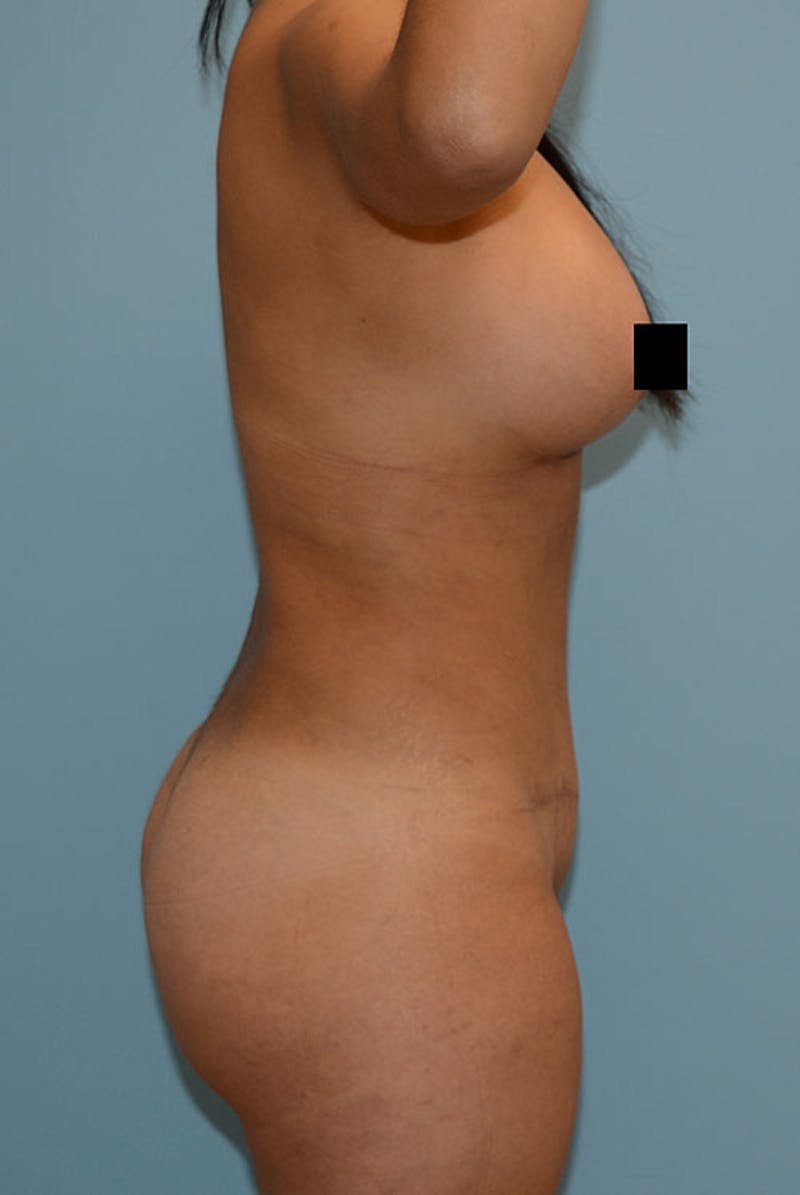 Brazilian Butt Lift Gallery - Patient 120904987 - Image 6