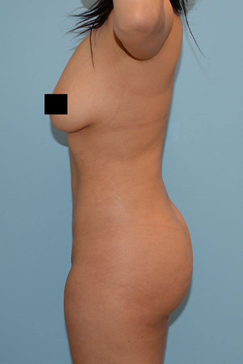 Brazilian Butt Lift Before & After Gallery - Patient 120905000 - Image 6