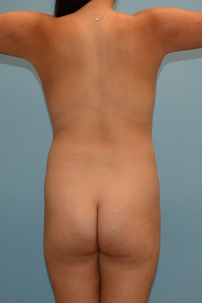 Brazilian Butt Lift Before & After Gallery - Patient 120905005 - Image 1