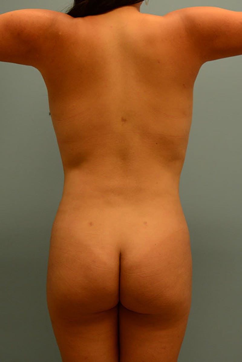 Brazilian Butt Lift Before & After Gallery - Patient 120905005 - Image 2