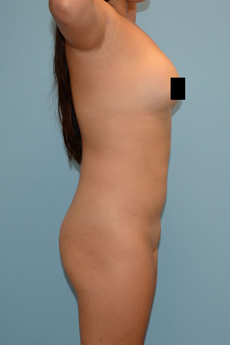 Brazilian Butt Lift Before & After Gallery - Patient 120905005 - Image 5
