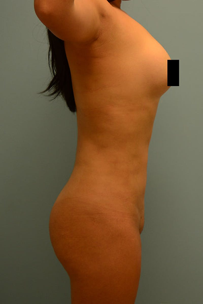 Brazilian Butt Lift Before & After Gallery - Patient 120905005 - Image 6