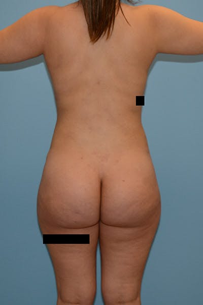 Brazilian Butt Lift Before & After Gallery - Patient 120905006 - Image 2