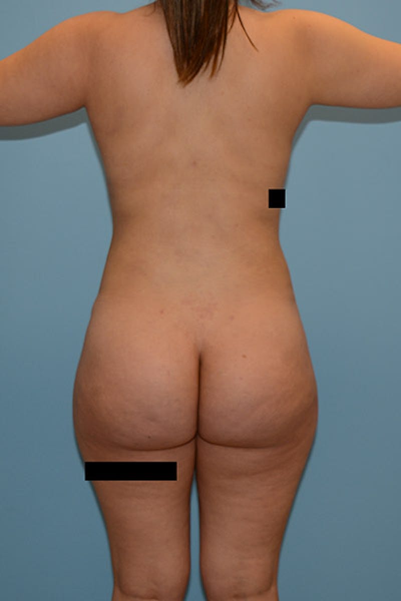 Brazilian Butt Lift Gallery - Patient 120905006 - Image 2