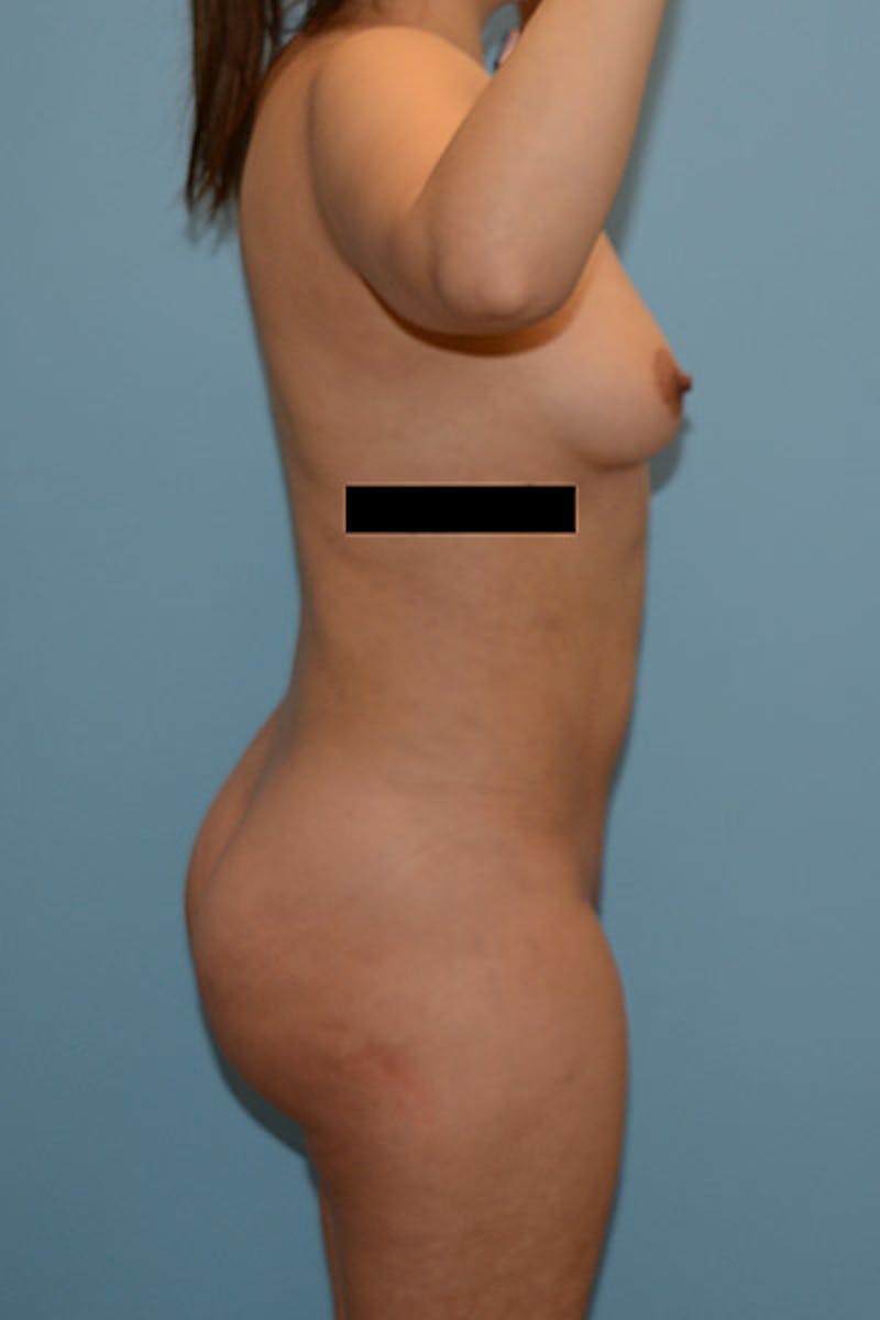 Brazilian Butt Lift Before & After Gallery - Patient 120905006 - Image 6