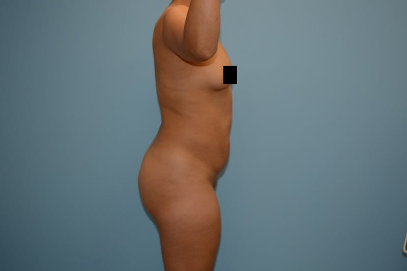 Brazilian Butt Lift Before & After Gallery - Patient 120905017 - Image 3