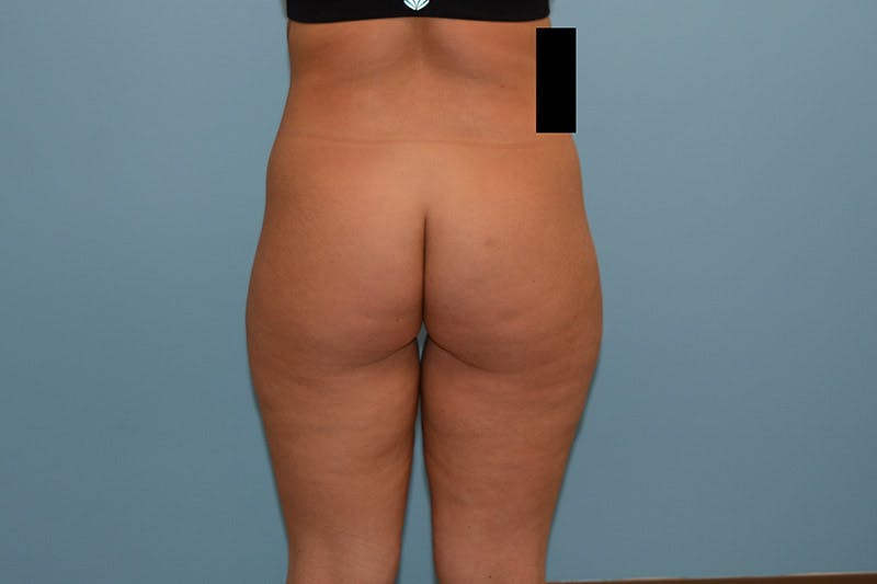 Brazilian Butt Lift Before & After Gallery - Patient 120905020 - Image 1