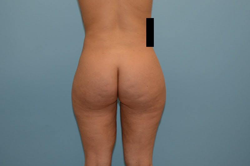 Brazilian Butt Lift Before & After Gallery - Patient 120905020 - Image 2