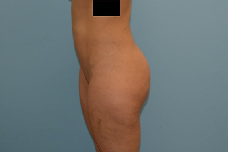 Brazilian Butt Lift Before & After Gallery - Patient 120905020 - Image 4
