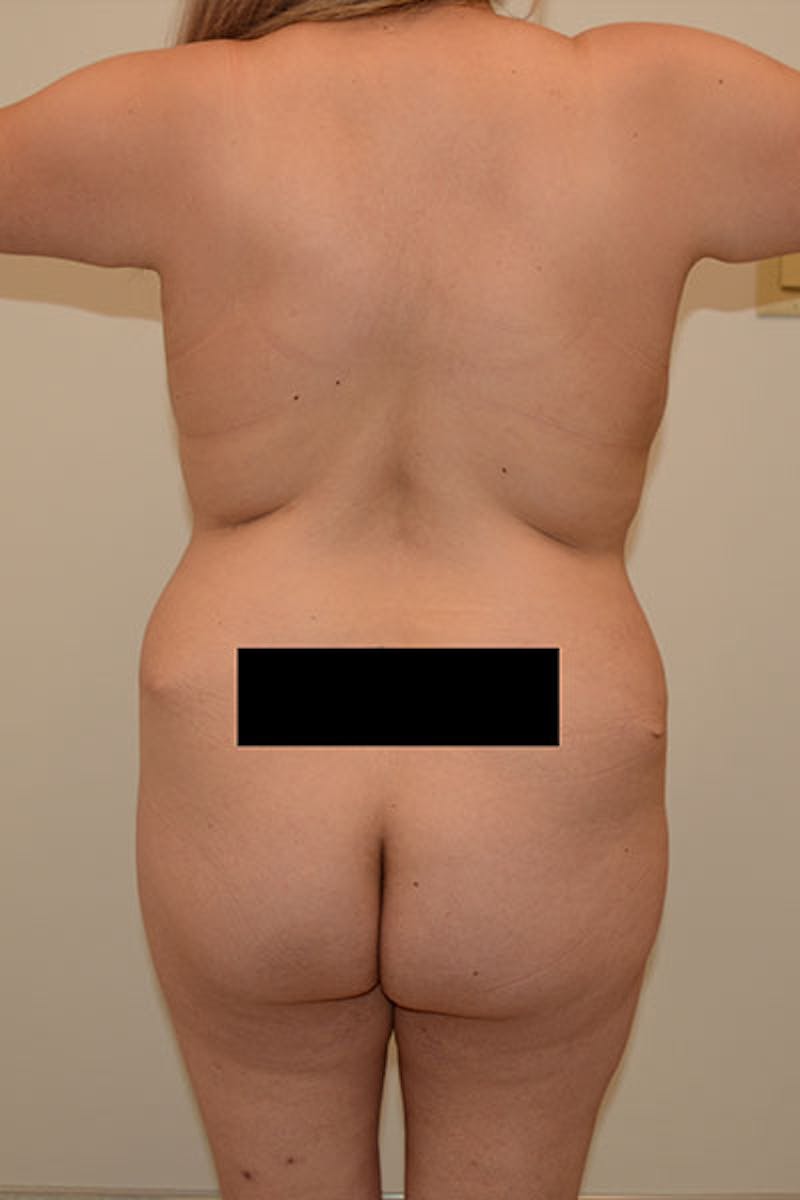 Brazilian Butt Lift Before & After Gallery - Patient 120905021 - Image 1