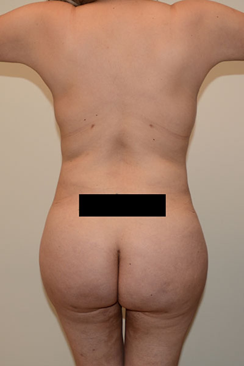 Brazilian Butt Lift Before & After Gallery - Patient 120905021 - Image 2
