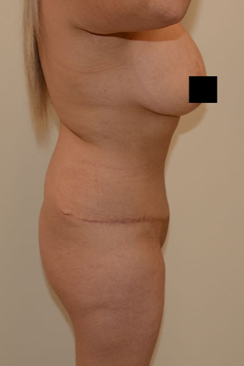 Brazilian Butt Lift Before & After Gallery - Patient 120905021 - Image 3
