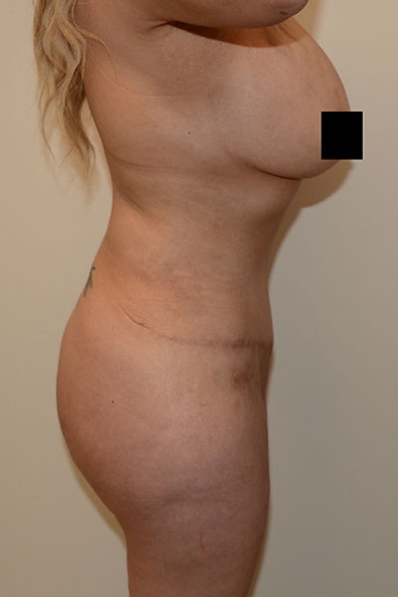 Brazilian Butt Lift Before & After Gallery - Patient 120905021 - Image 4