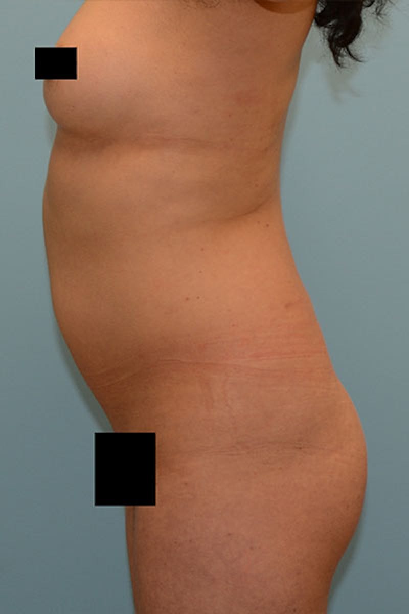 Brazilian Butt Lift Before & After Gallery - Patient 120905022 - Image 3