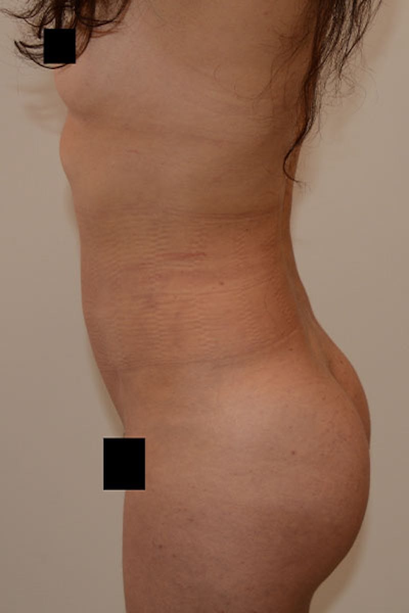 Brazilian Butt Lift Before & After Gallery - Patient 120905022 - Image 4