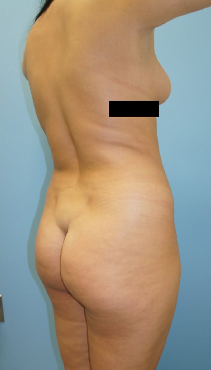 Brazilian Butt Lift Before & After Gallery - Patient 120905023 - Image 1
