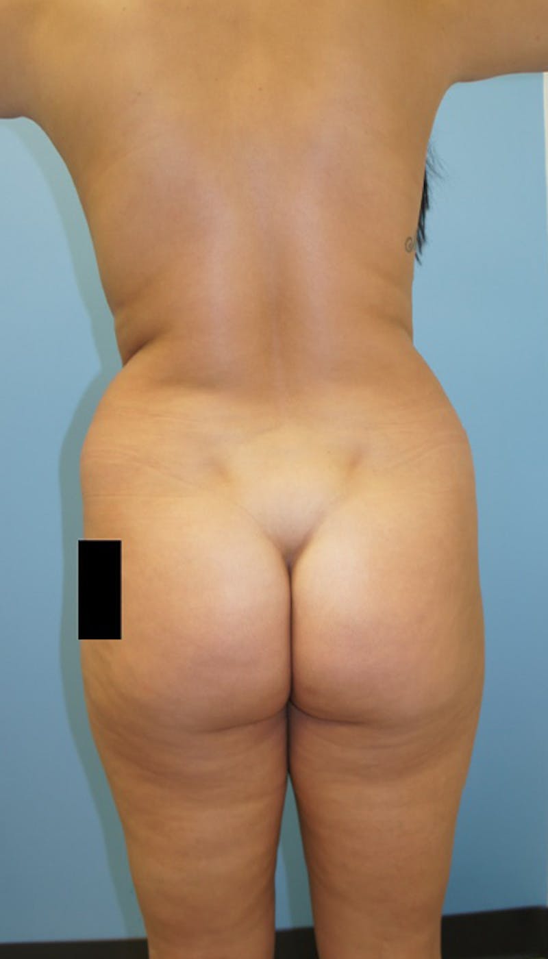 Brazilian Butt Lift Before & After Gallery - Patient 120905023 - Image 3