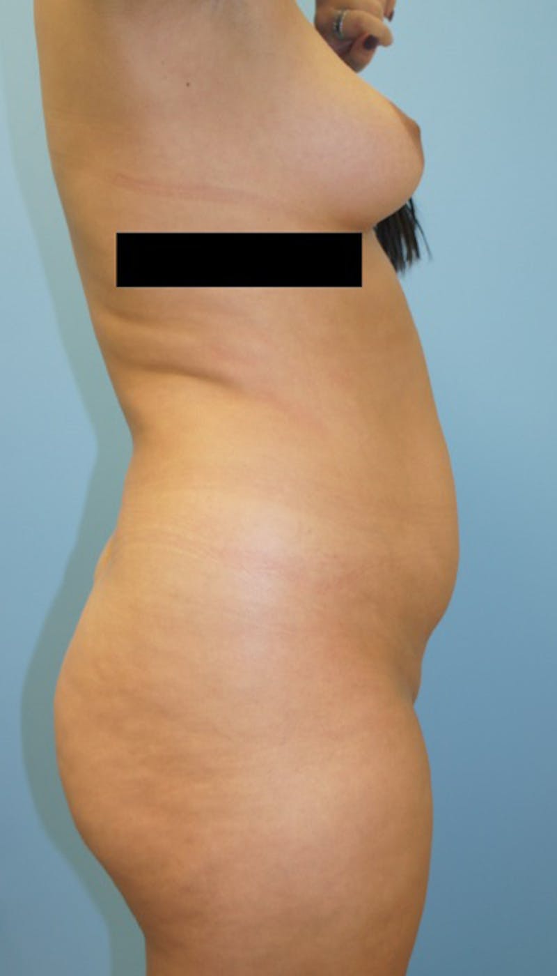 Brazilian Butt Lift Before & After Gallery - Patient 120905023 - Image 5