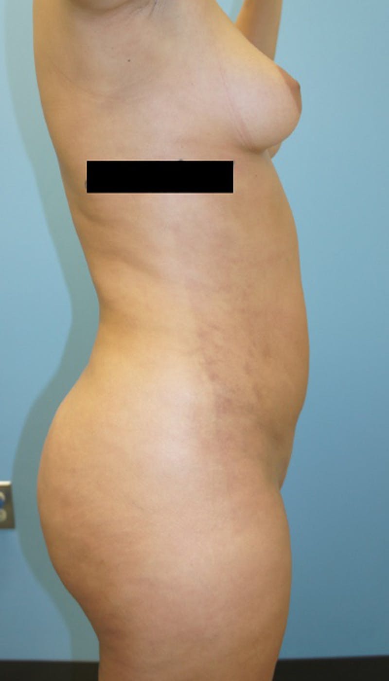 Brazilian Butt Lift Before & After Gallery - Patient 120905023 - Image 6