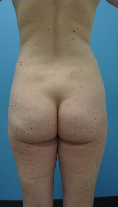 Brazilian Butt Lift Before & After Gallery - Patient 120905024 - Image 1