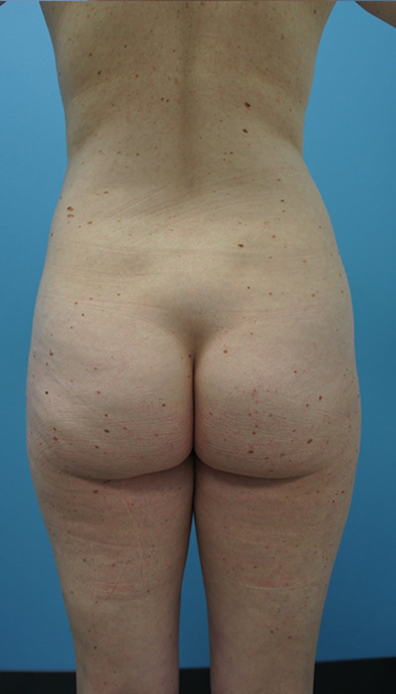 Brazilian Butt Lift Before & After Gallery - Patient 120905024 - Image 1
