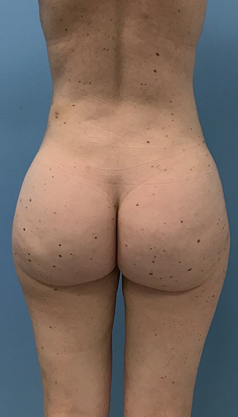 Brazilian Butt Lift Gallery - Patient 120905024 - Image 2