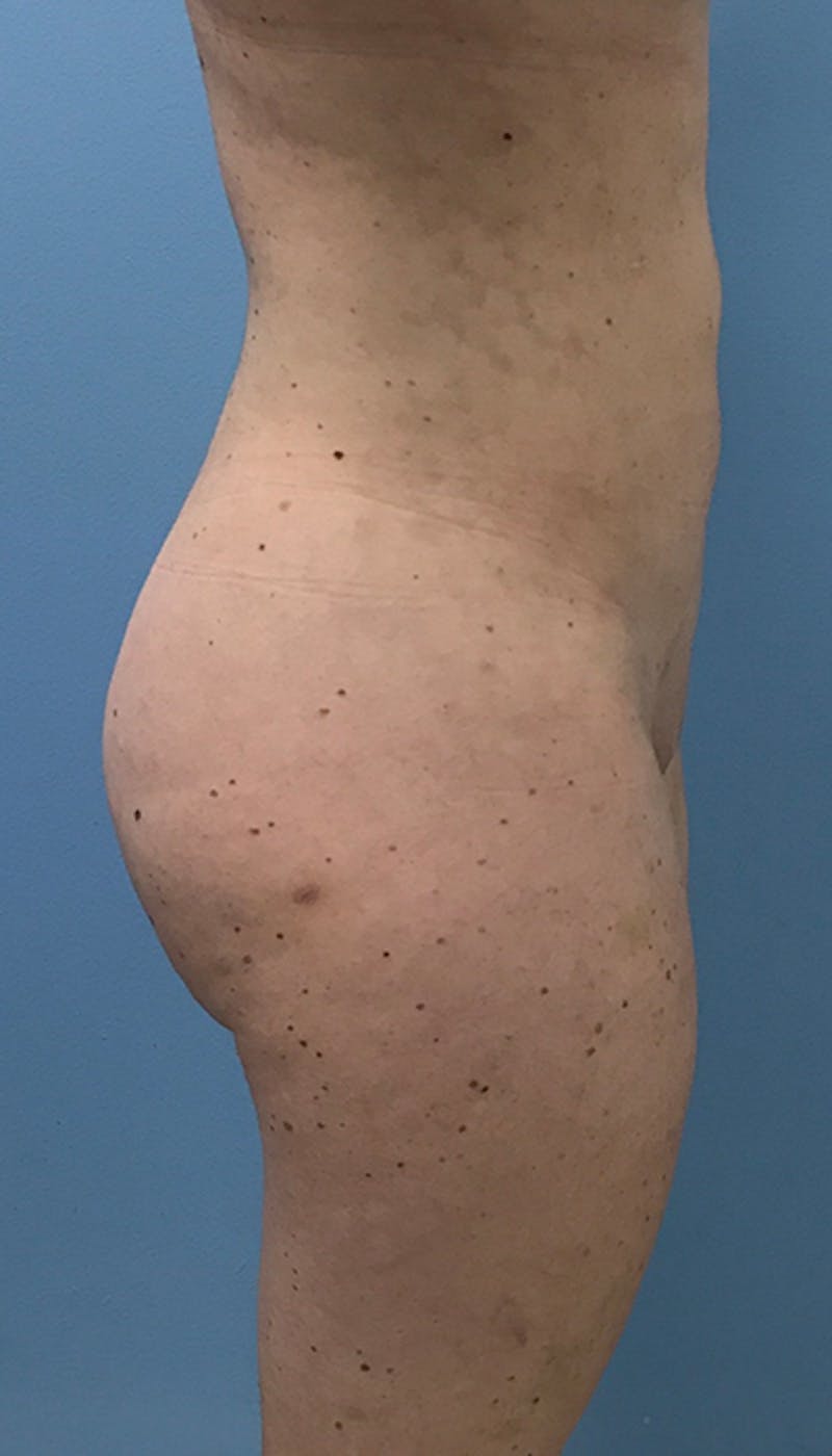 Brazilian Butt Lift Before & After Gallery - Patient 120905024 - Image 4