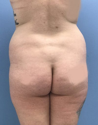 Brazilian Butt Lift Before & After Gallery - Patient 120905026 - Image 1
