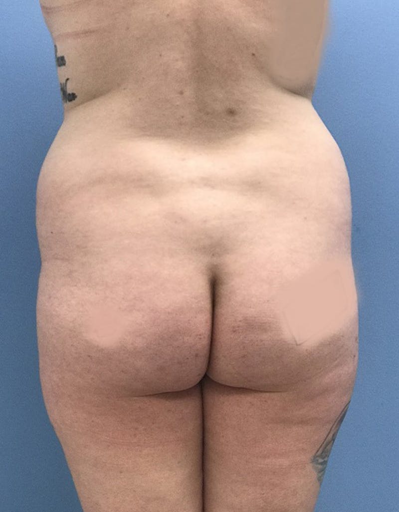 Brazilian Butt Lift Gallery - Patient 120905026 - Image 1