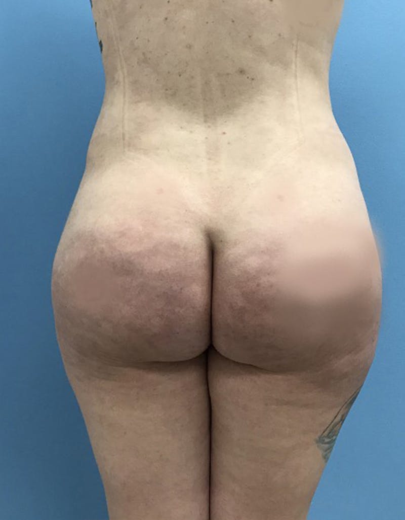 Brazilian Butt Lift Before & After Gallery - Patient 120905026 - Image 2