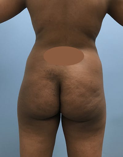 Brazilian Butt Lift Before & After Gallery - Patient 120905028 - Image 1